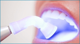 sbiancamento denti