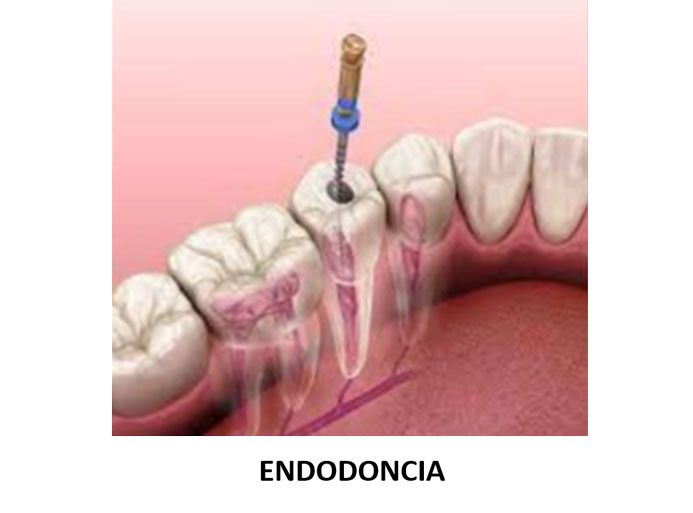 SMILIN CONSULTORIO DENTAL - ENDODONCIA