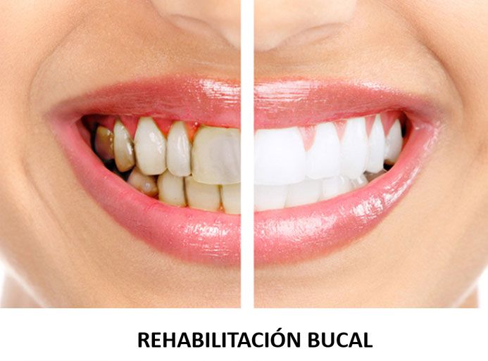 SMILIN CONSULTORIO DENTAL - Rehabilitación bucal
