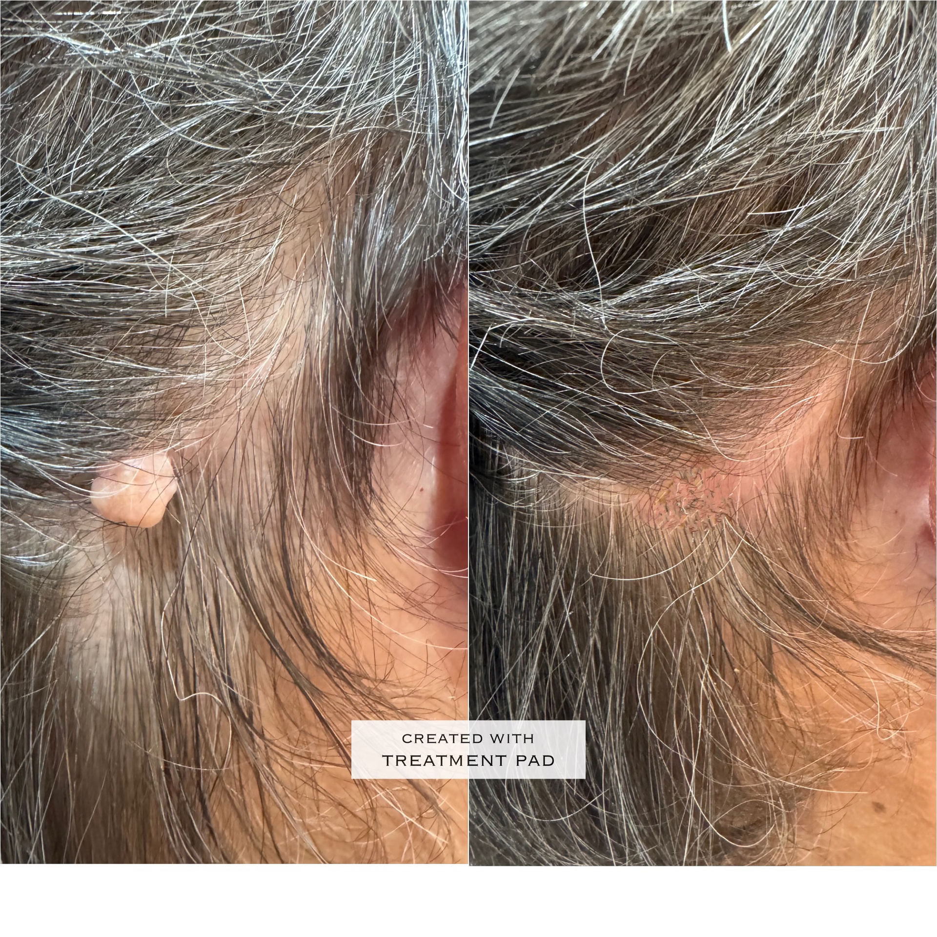 Mole removed from hair