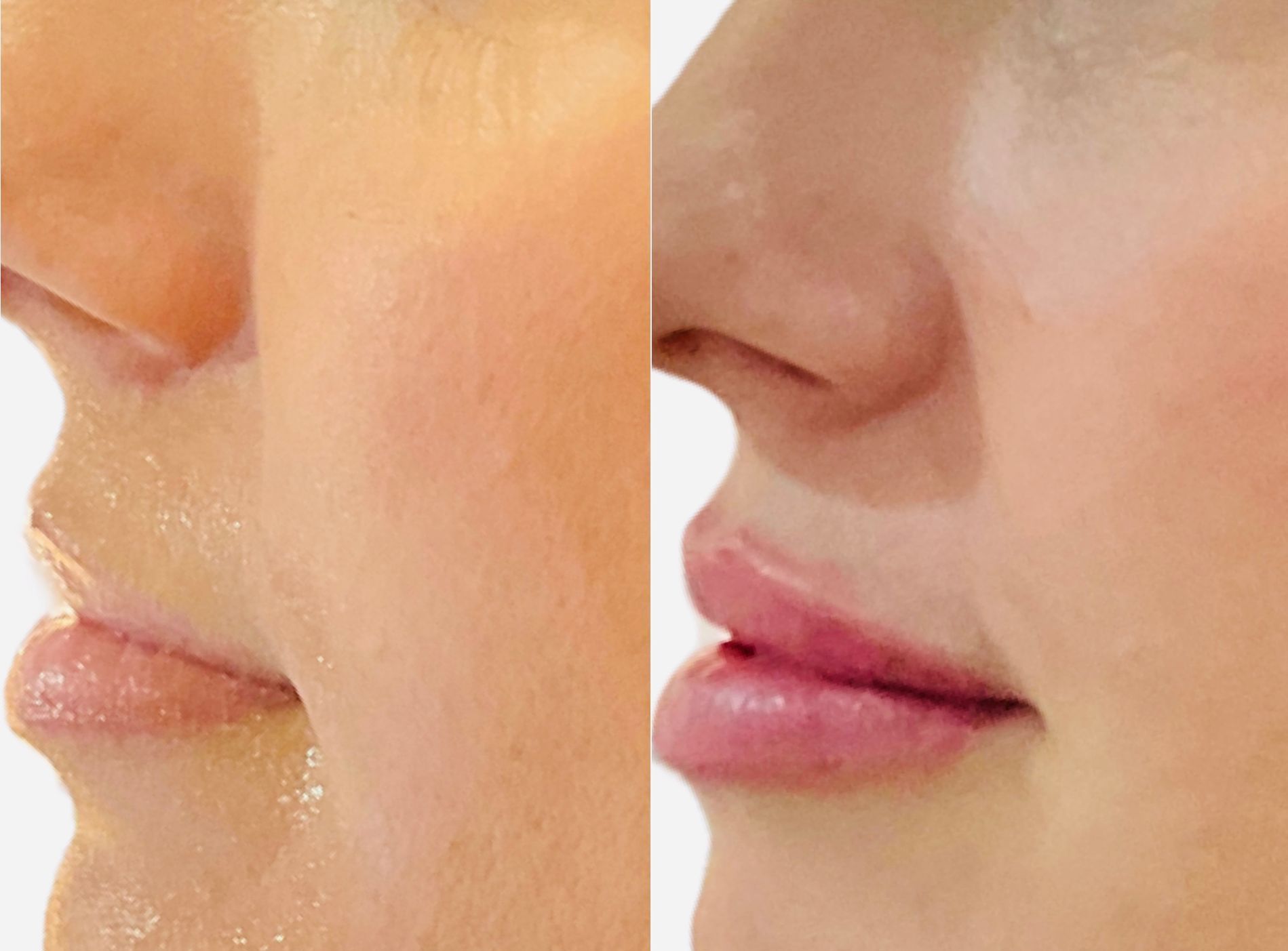 Lips with dermal filler