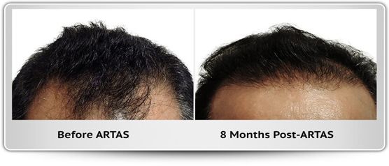 A before and after photo of a man 's hair