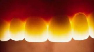 Transluzenz - ganz natürlich schimmert das Licht durch den Zahnkürper wie bei eigenen Zähnen