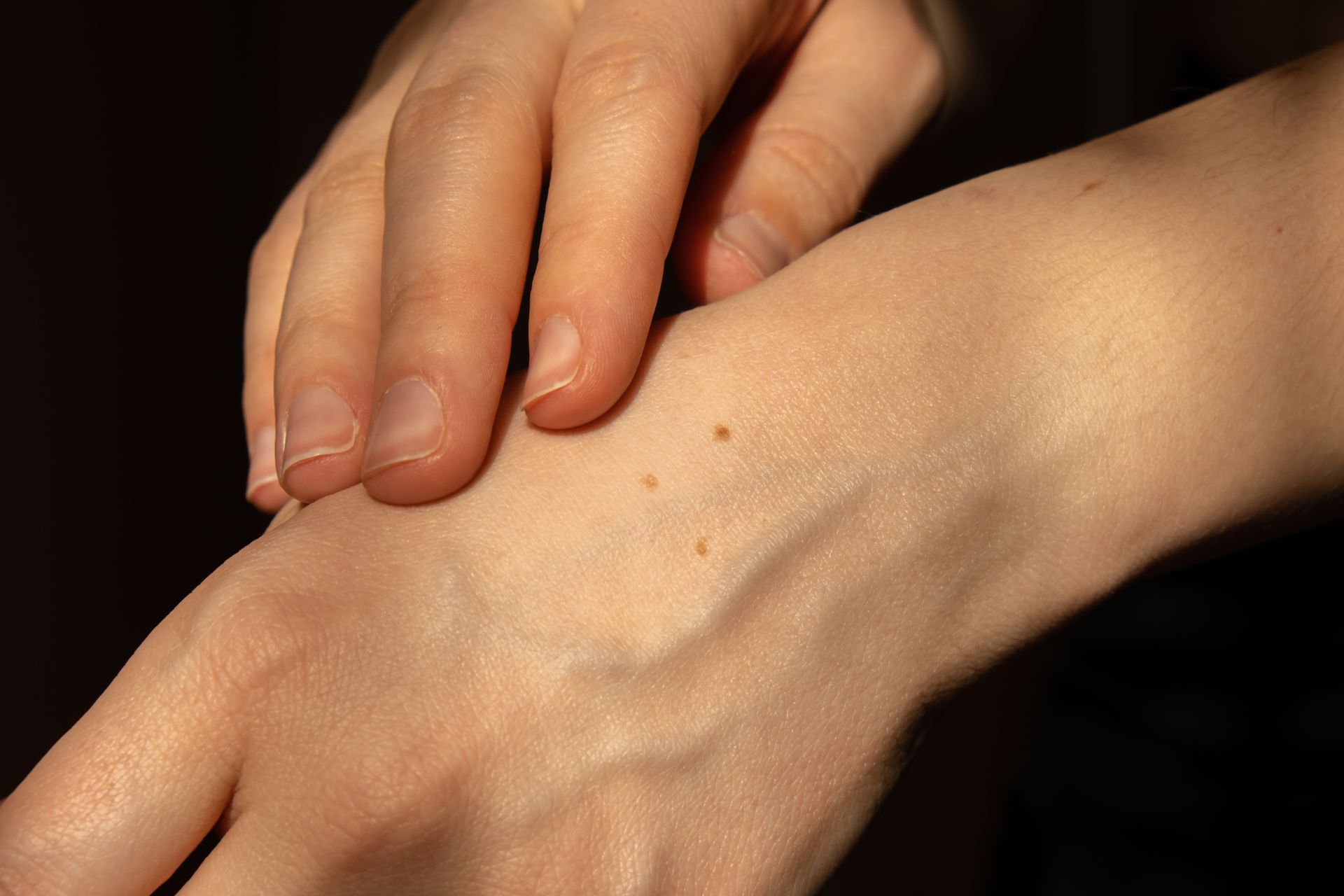 closeup of birthmarks on hands