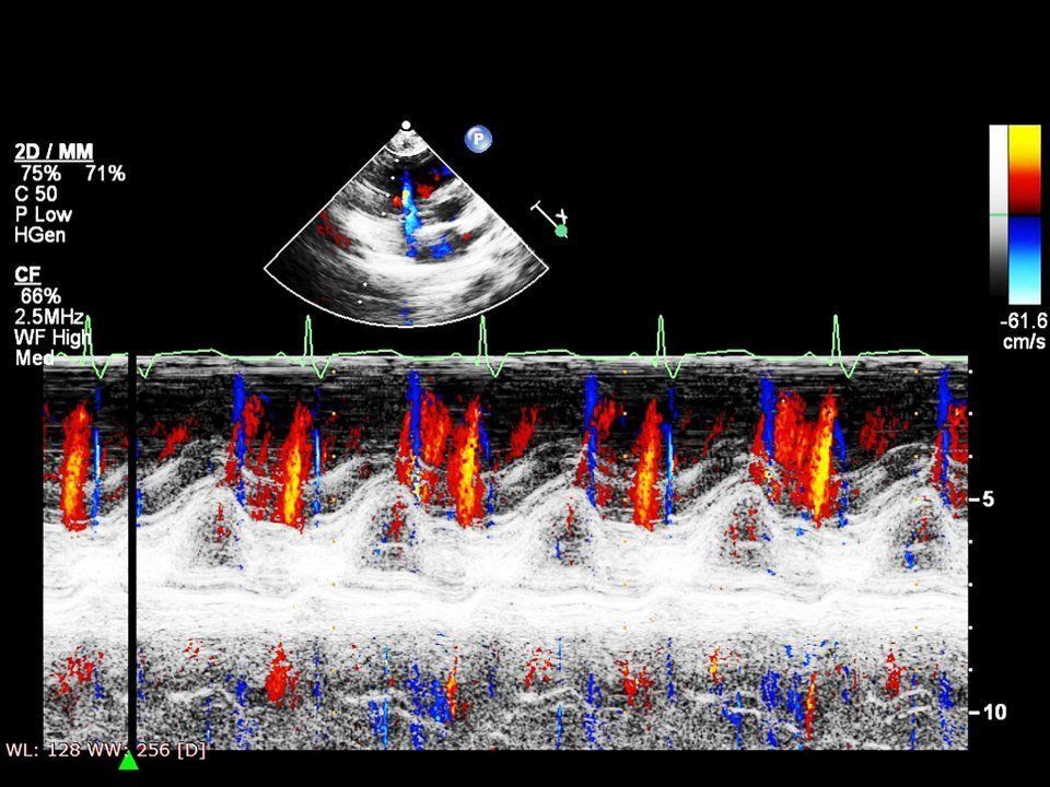ECOCOLOR DOPPLER