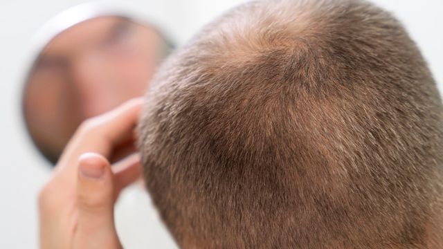 does tirzepatide make your hair fall out Can Mounjaro cause hair loss? Hair thinning side effects explained