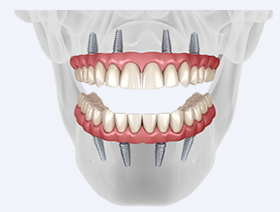 A model of a person's teeth with dental implants.