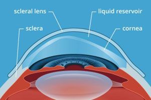 – Scleral contact lenses