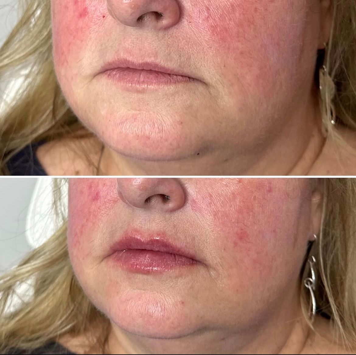 A before and after photo of a woman 's face with red spots.