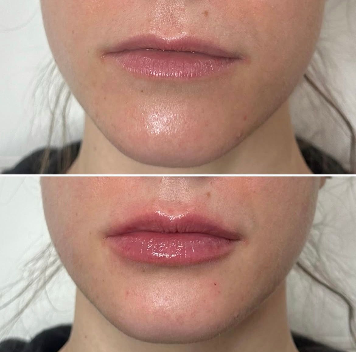 A before and after photo of a woman 's lips.