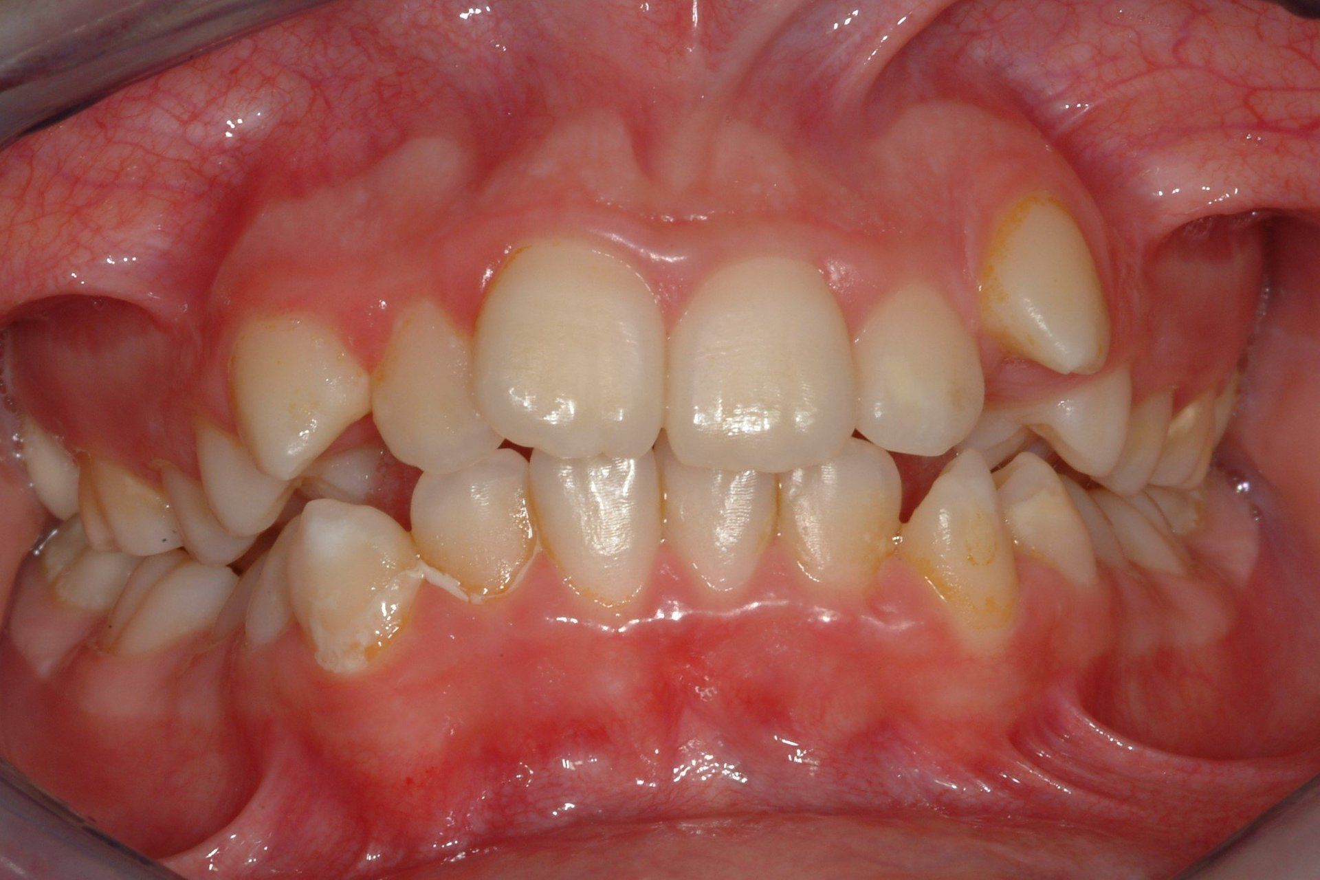 primo piano di denti paziente 5