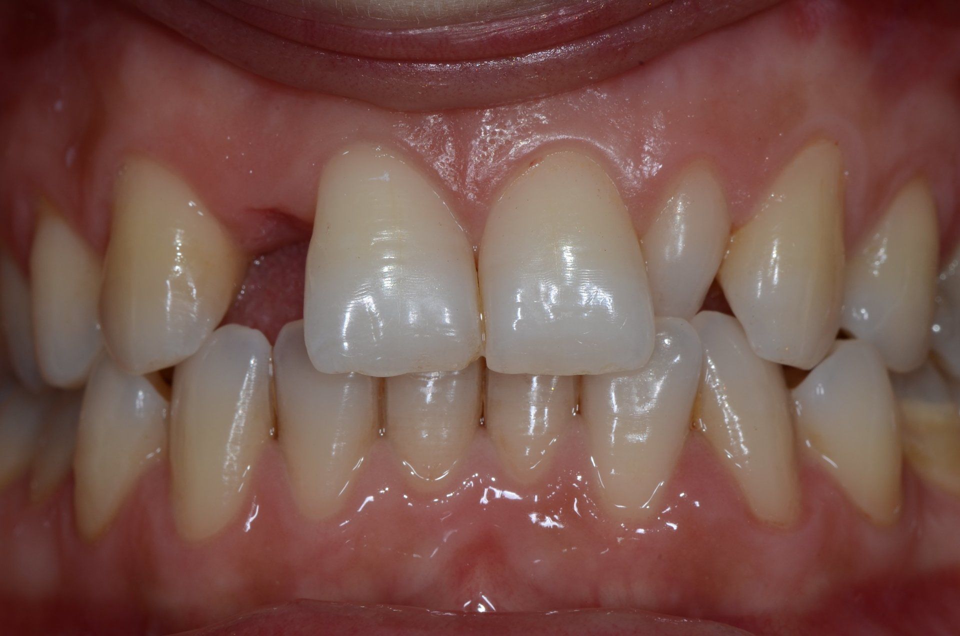 primo piano di denti paziente 12