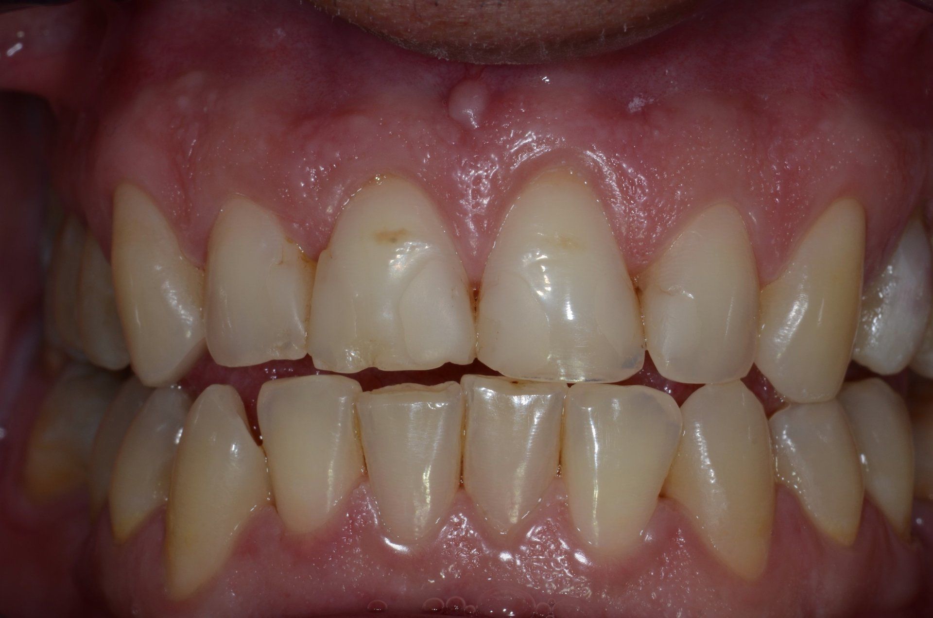 primo piano di denti paziente 22