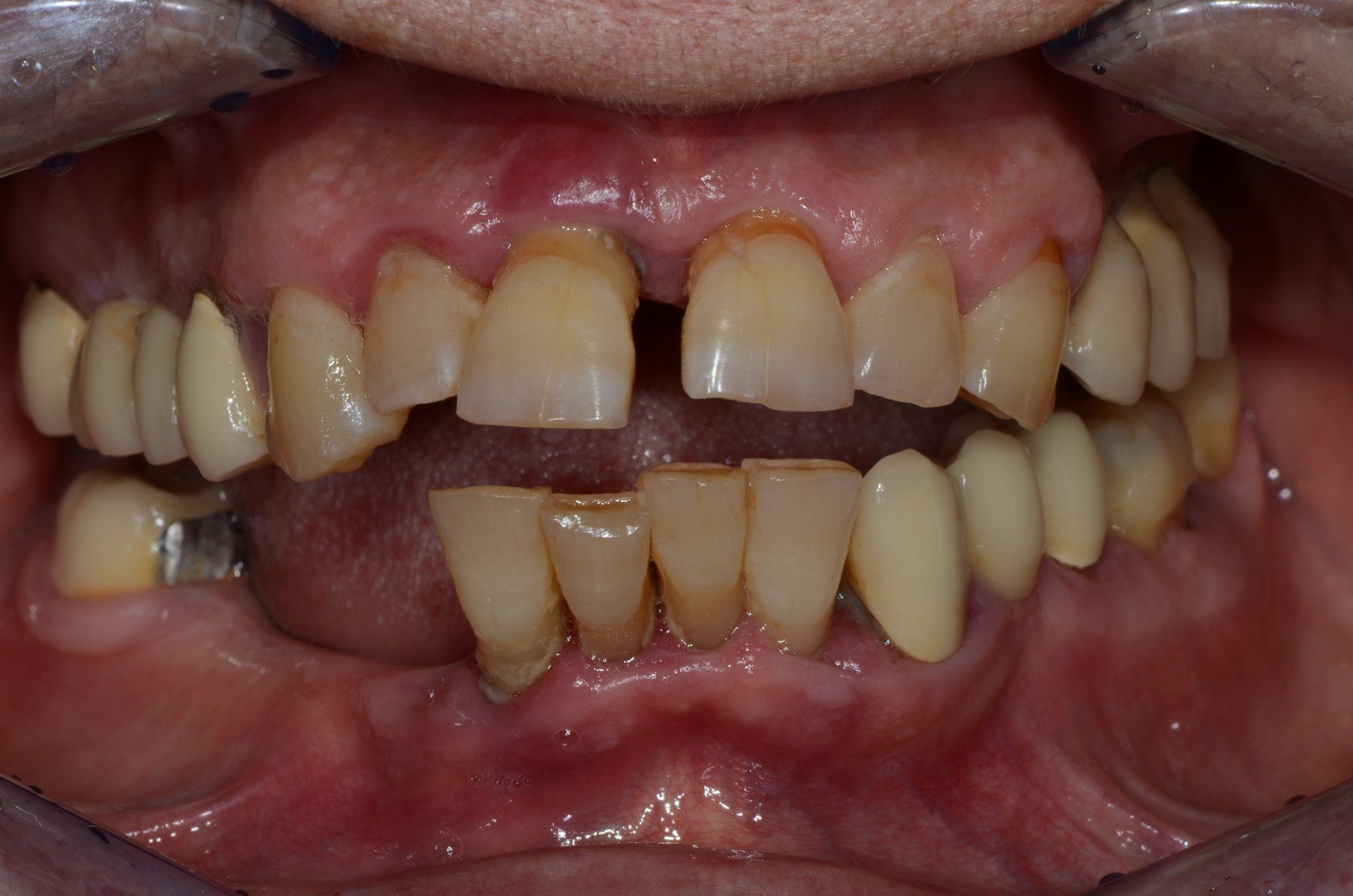 primo piano di denti paziente 15