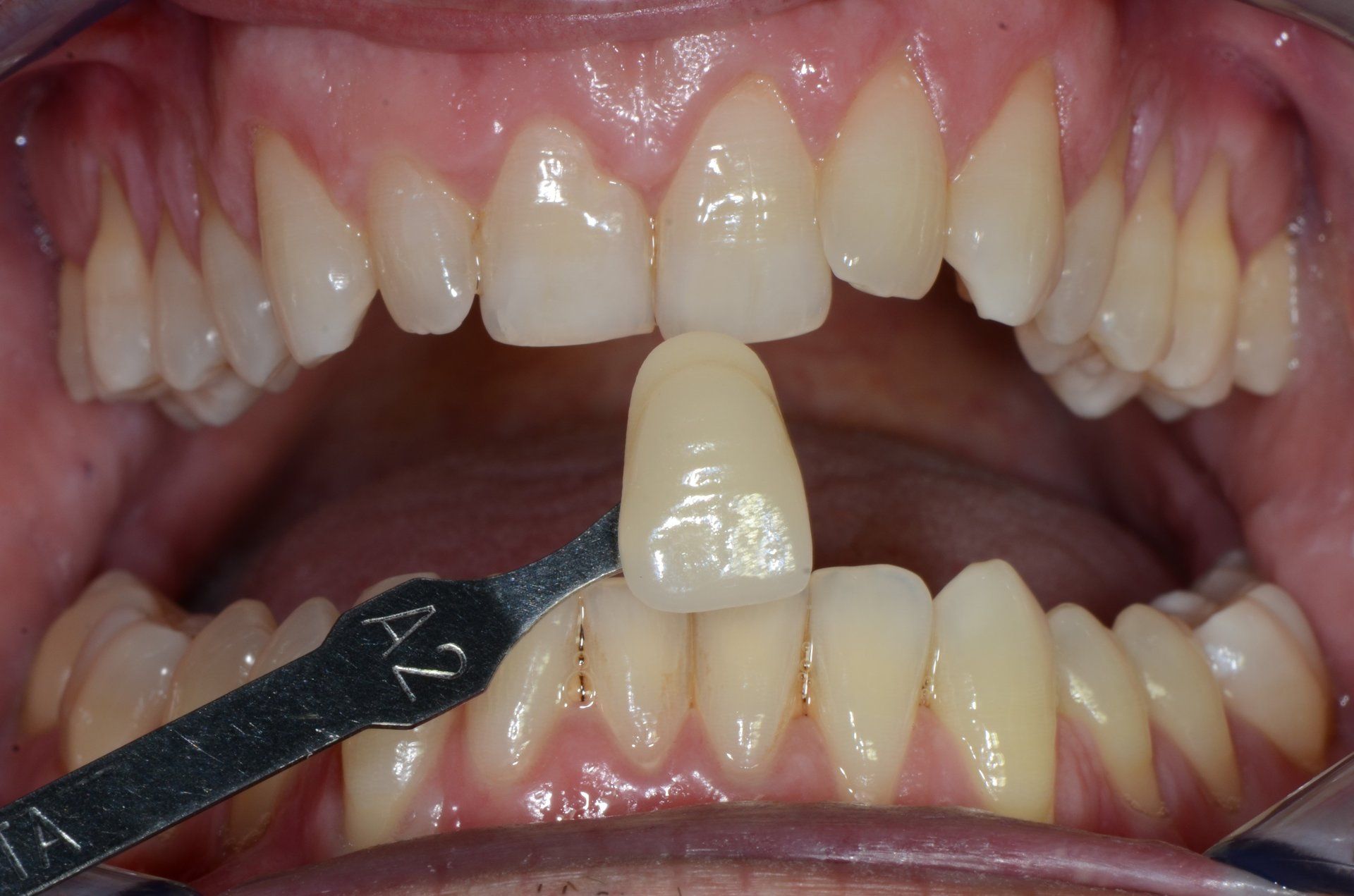 primo piano di denti paziente 3
