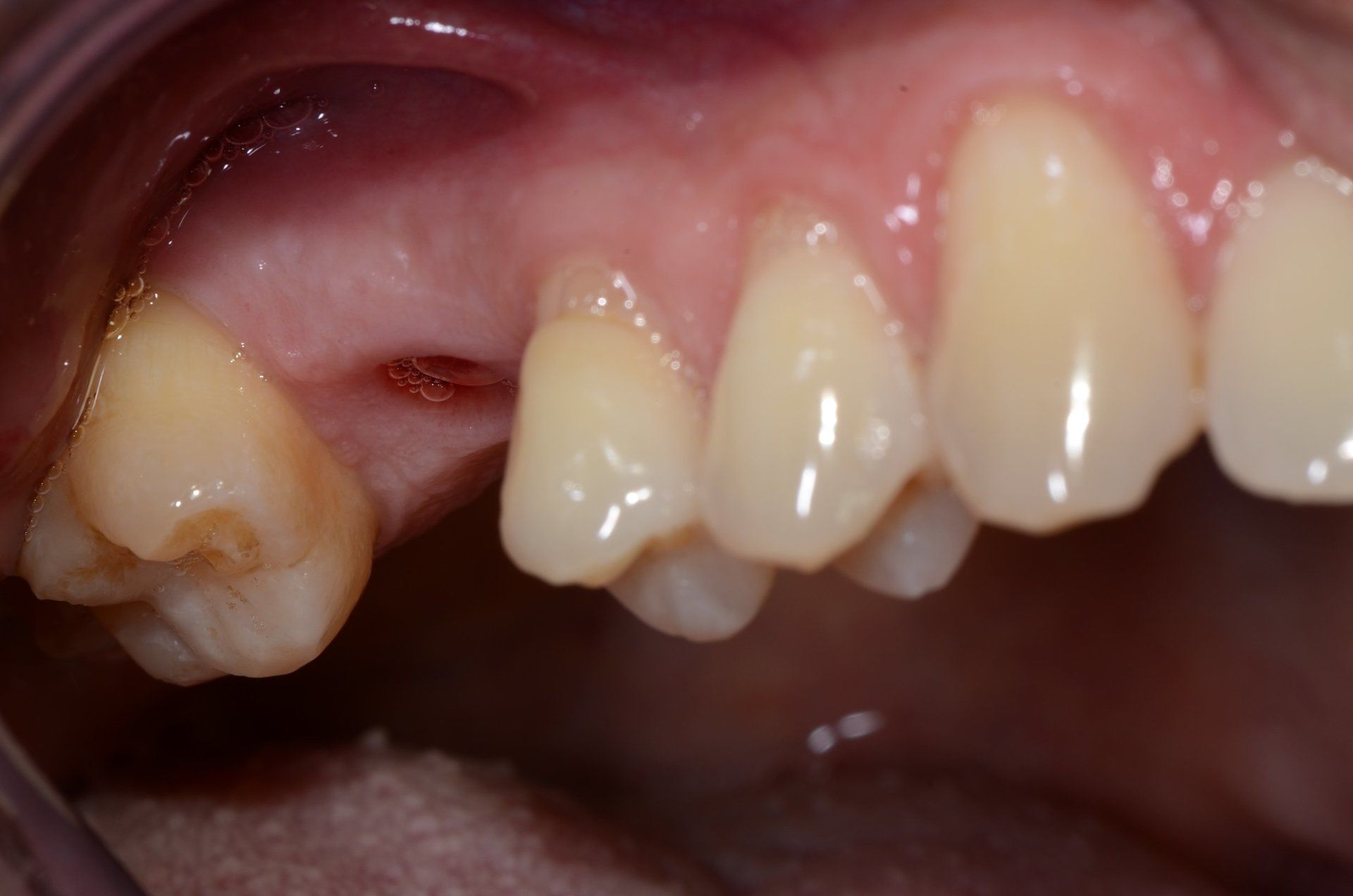 primo piano di denti paziente 19