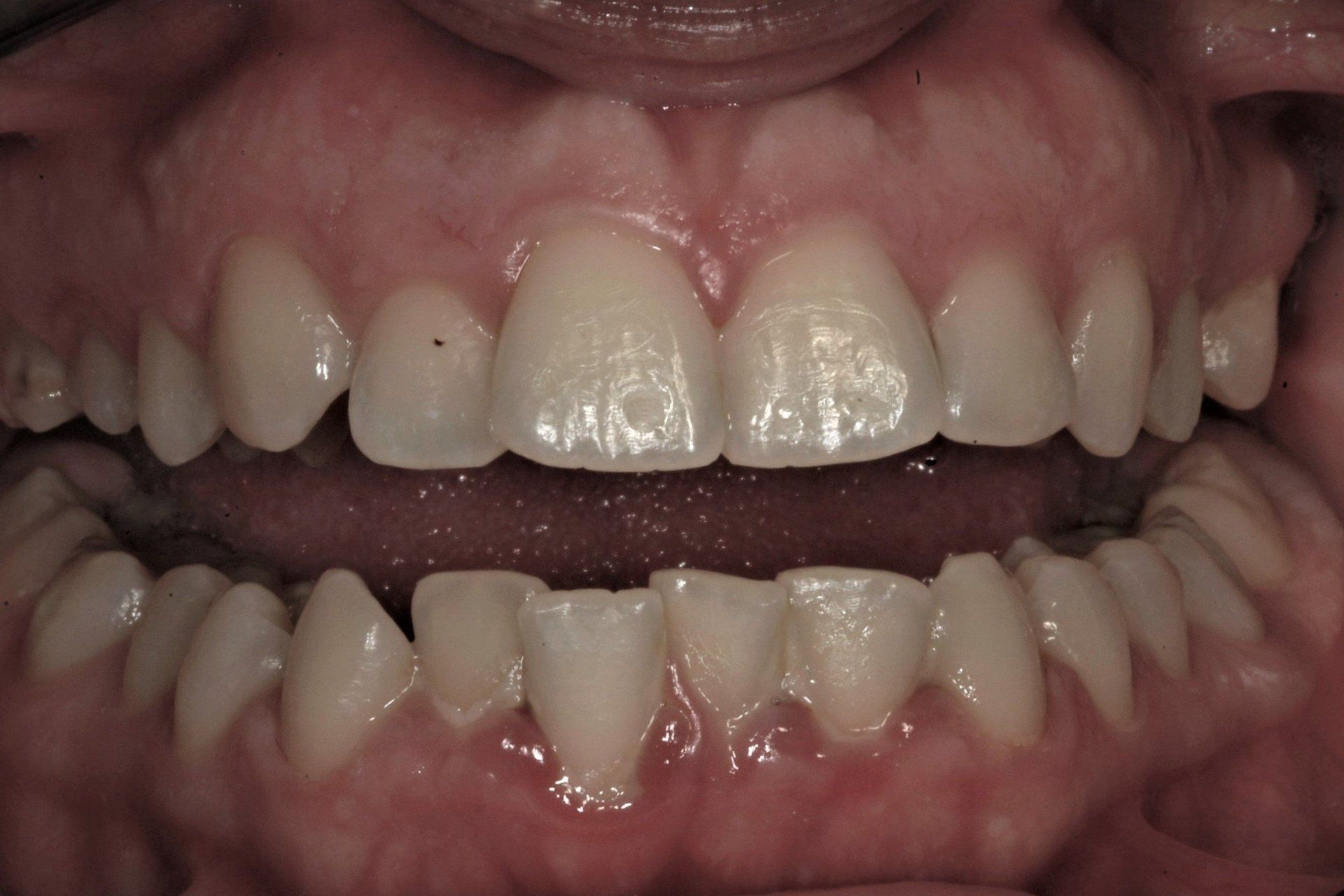 primo piano di denti paziente 9