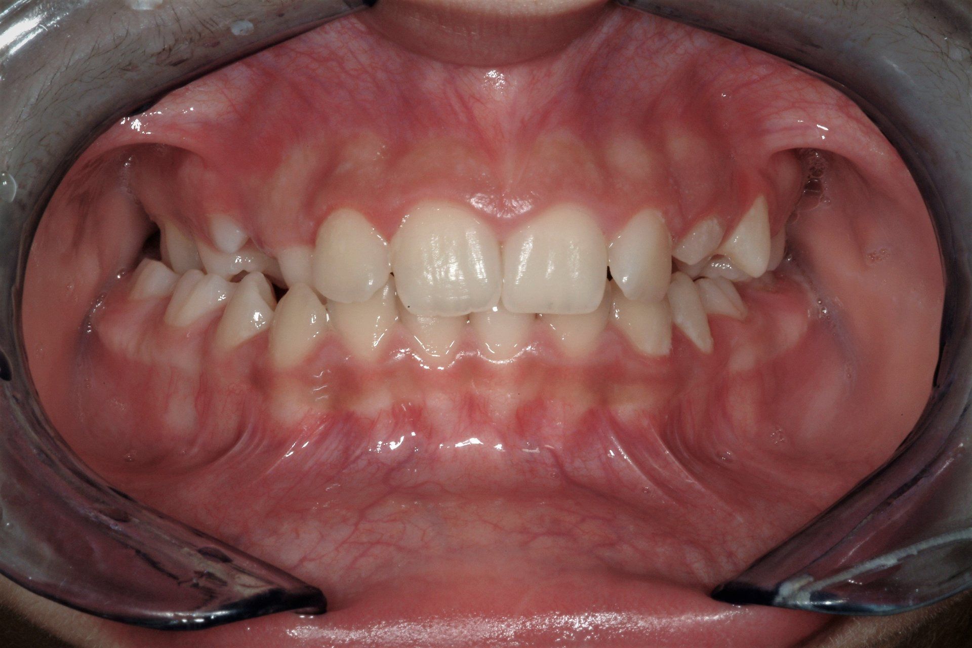 primo piano di denti paziente 11