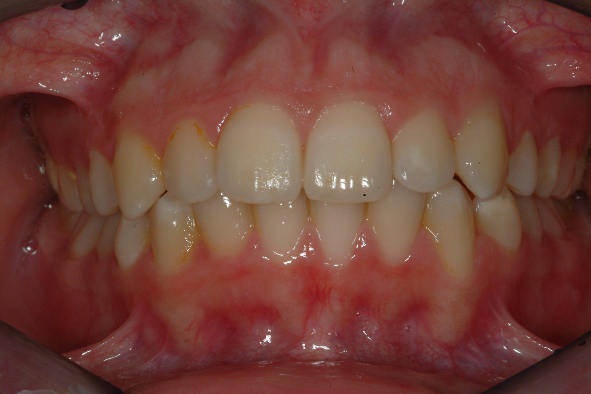 primo piano di denti paziente 6
