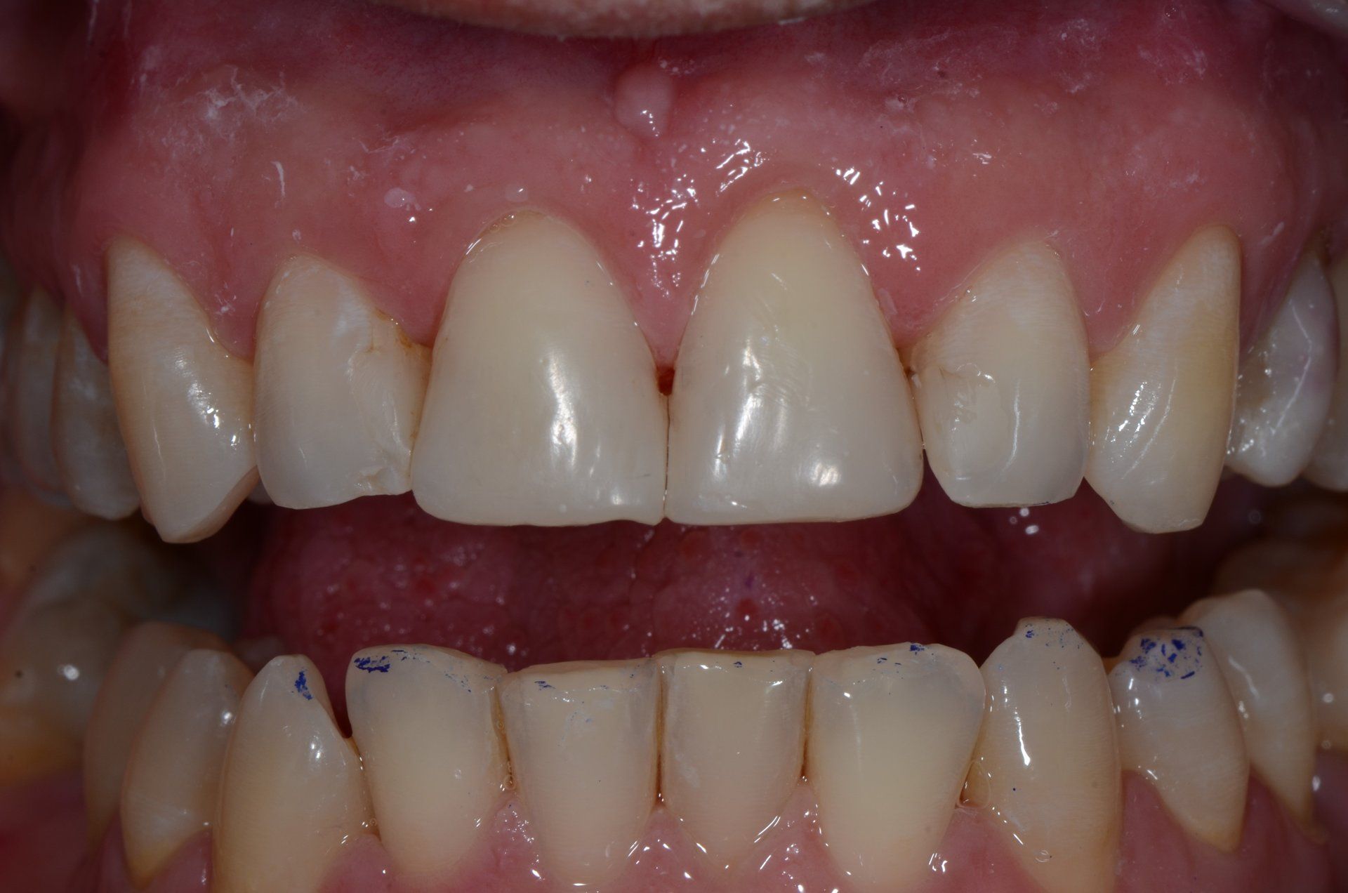 primo piano di denti paziente 21
