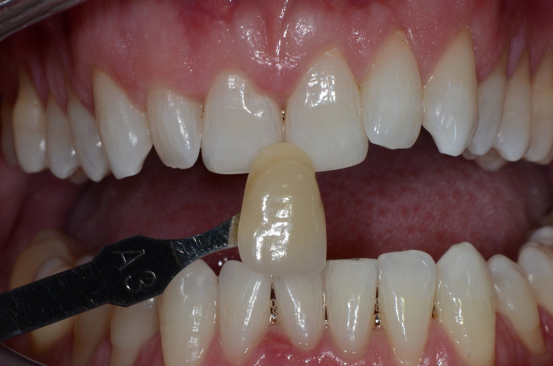 primo piano di denti paziente 4