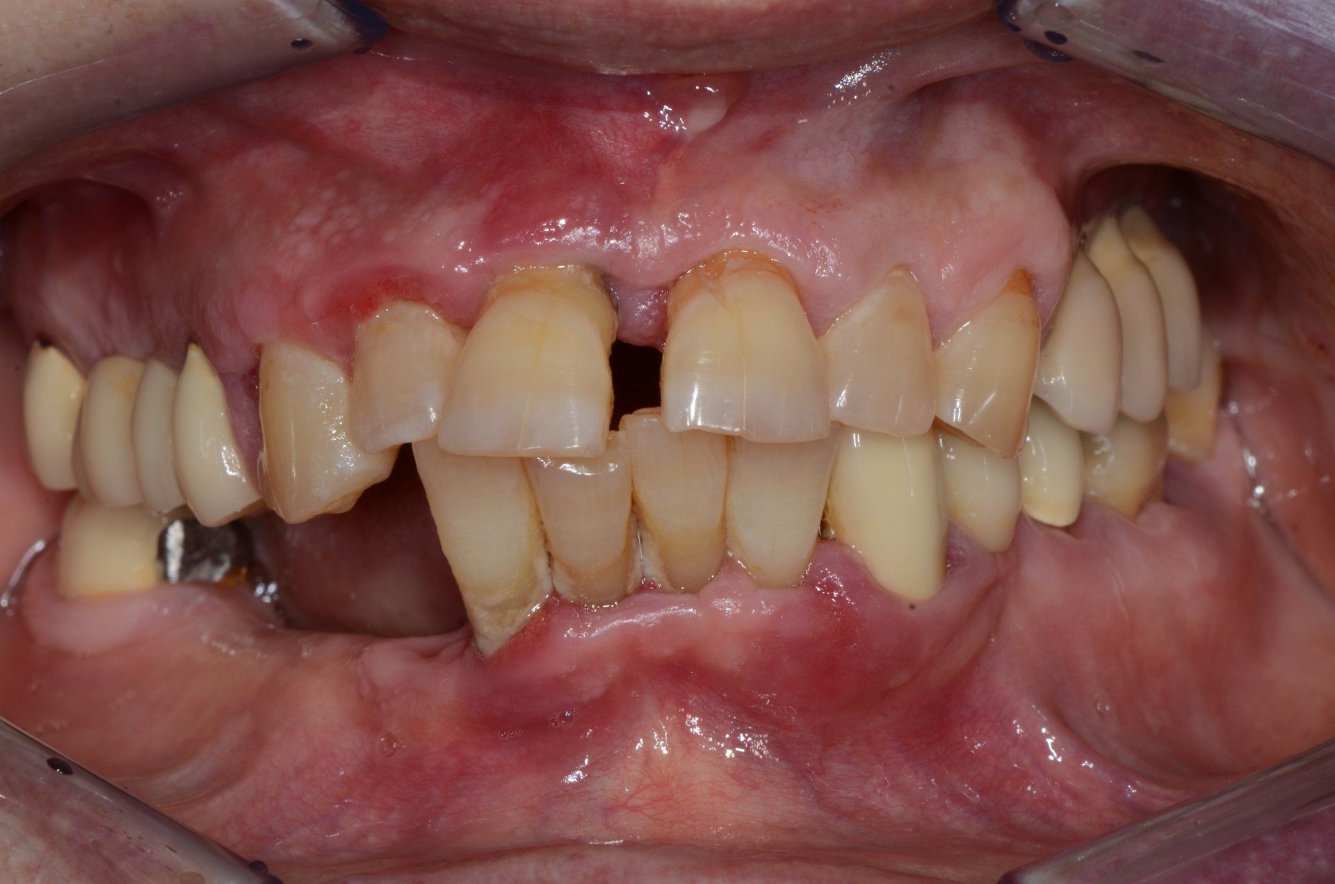 primo piano di denti paziente 14