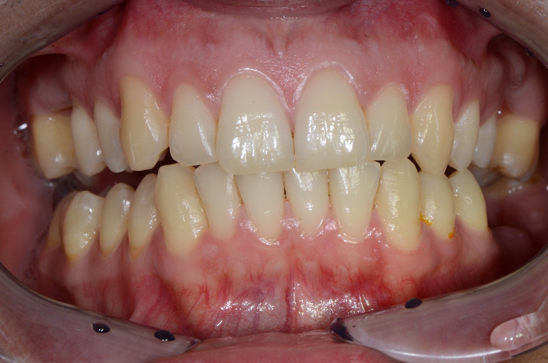 primo piano di denti paziente 1