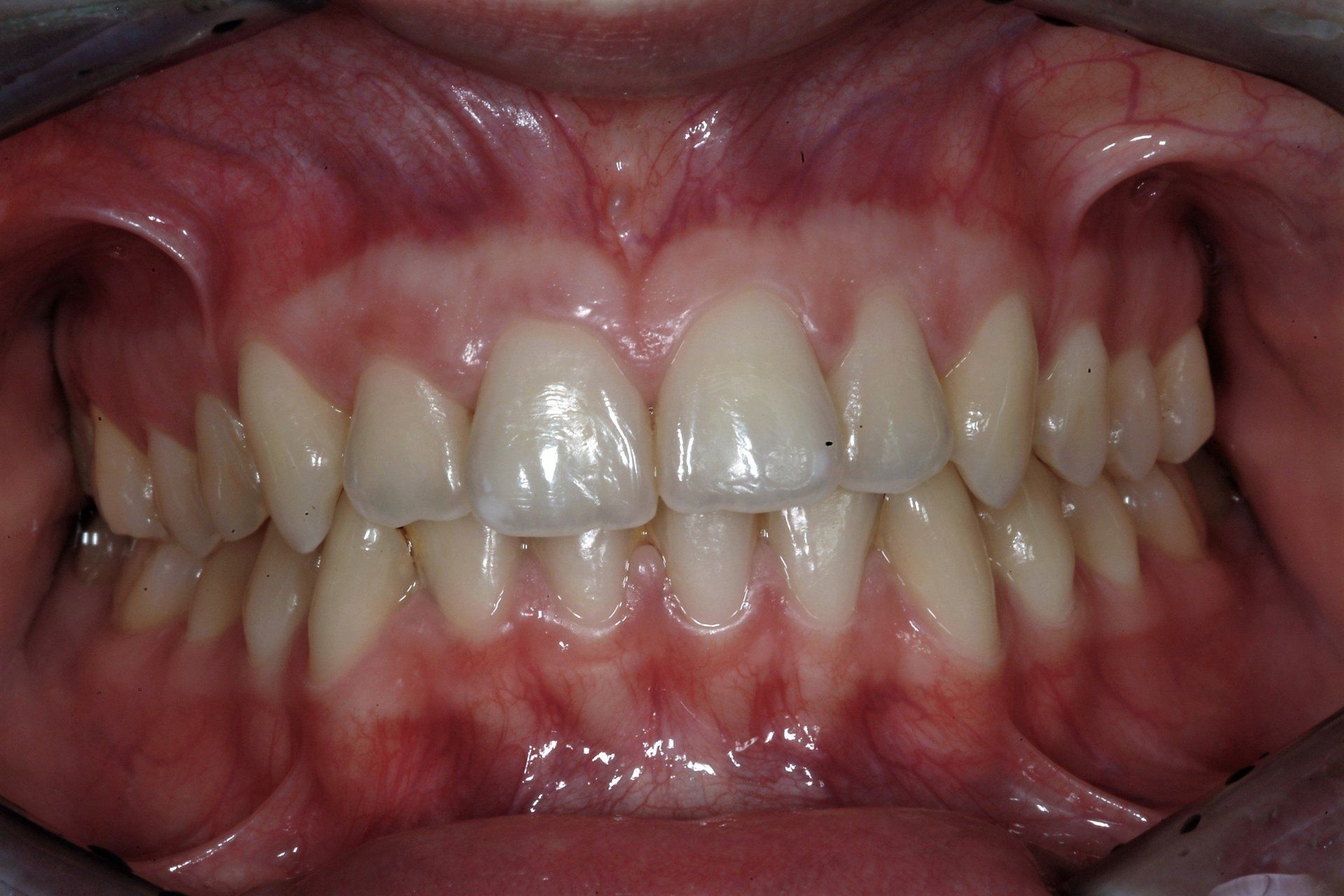 primo piano di denti paziente 8