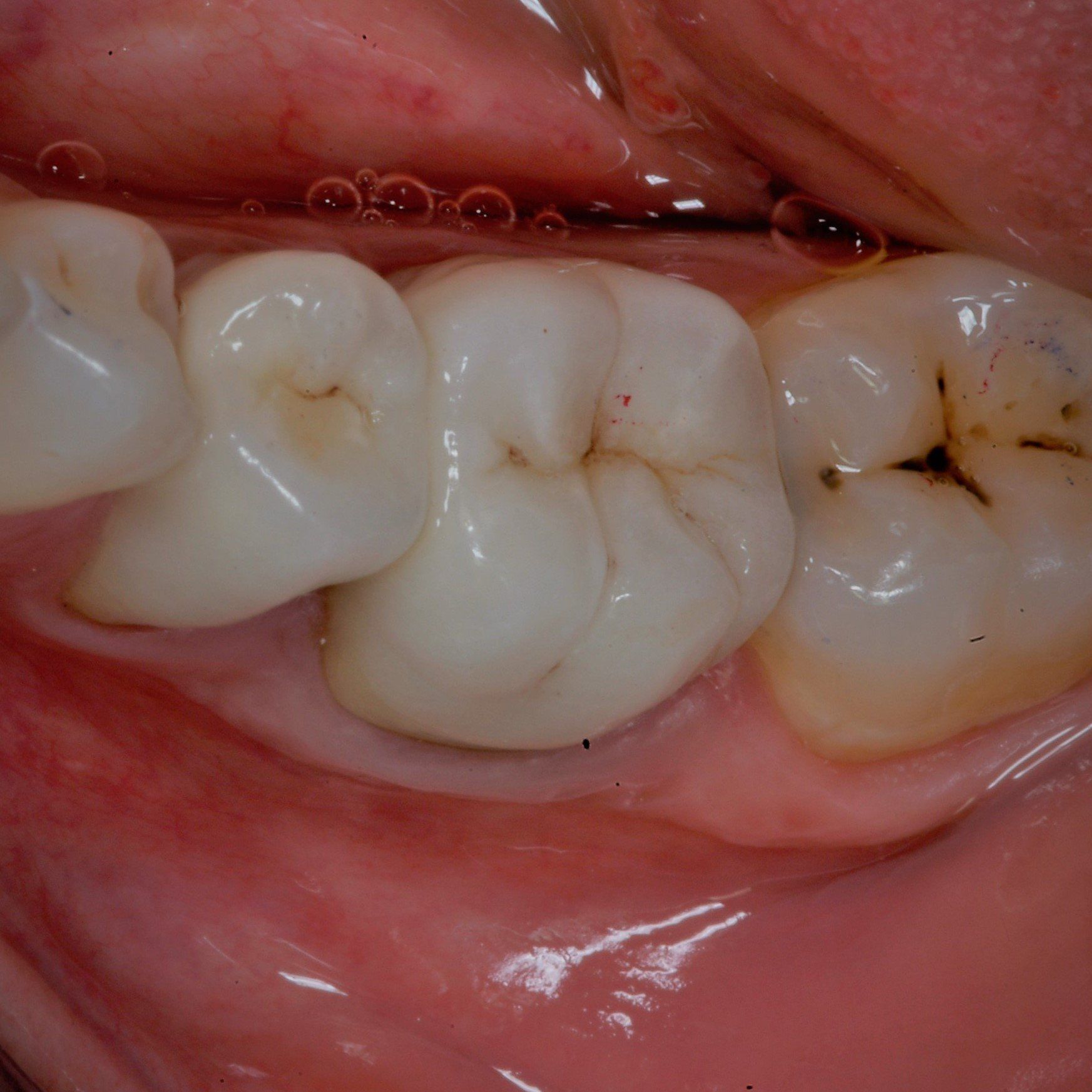 primo piano di denti paziente 19