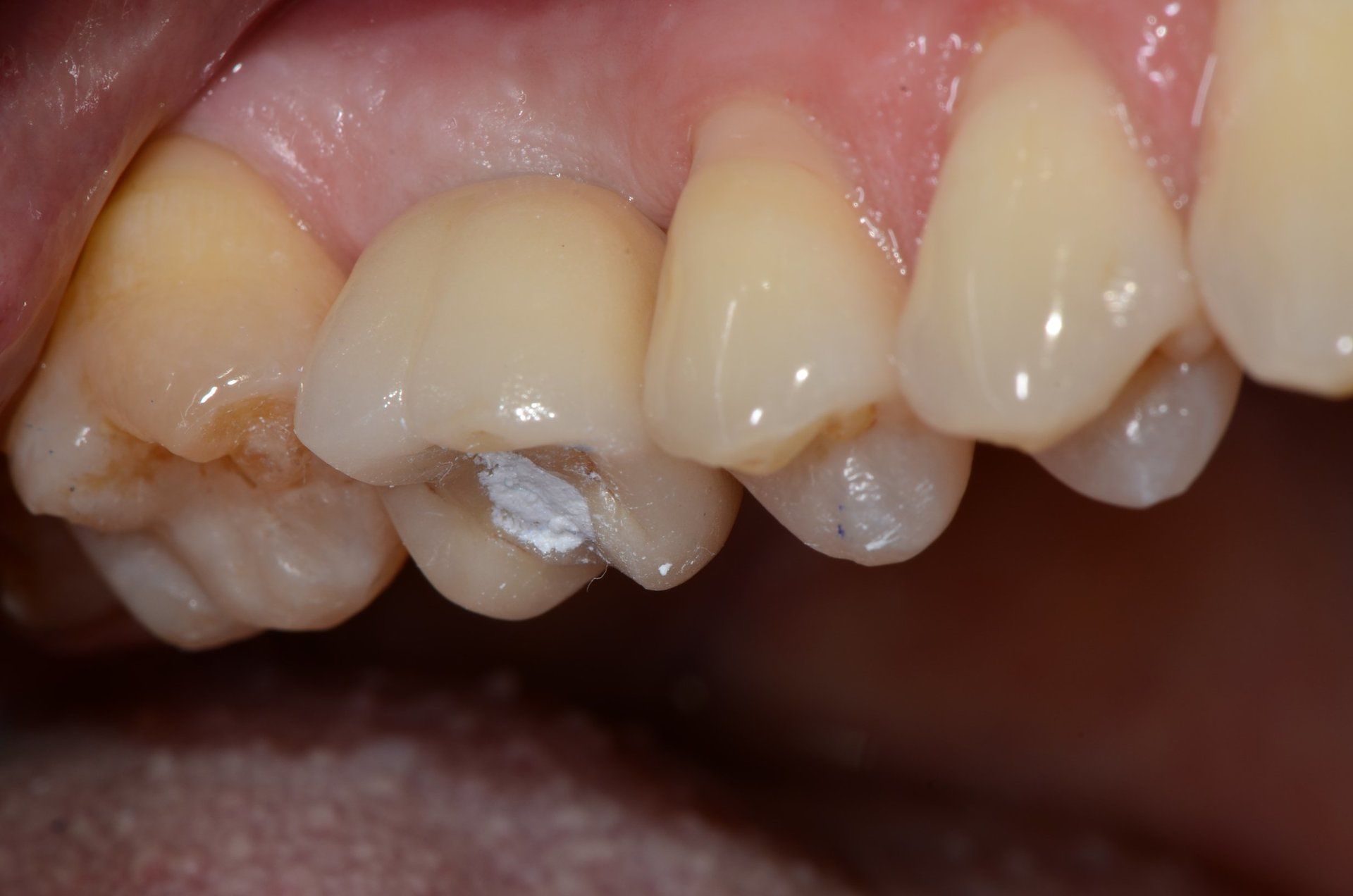 primo piano di denti paziente 18