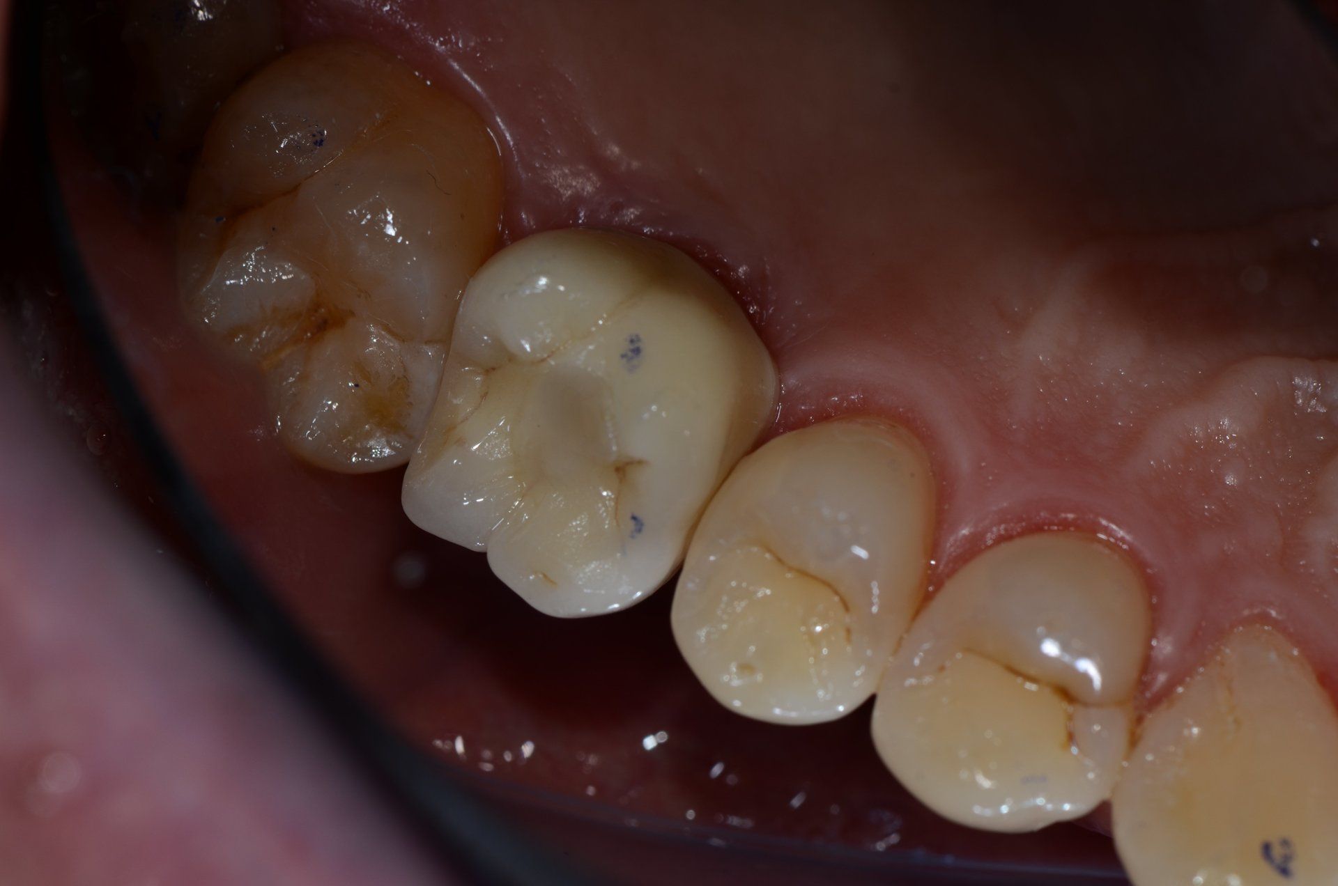 primo piano di denti paziente 17