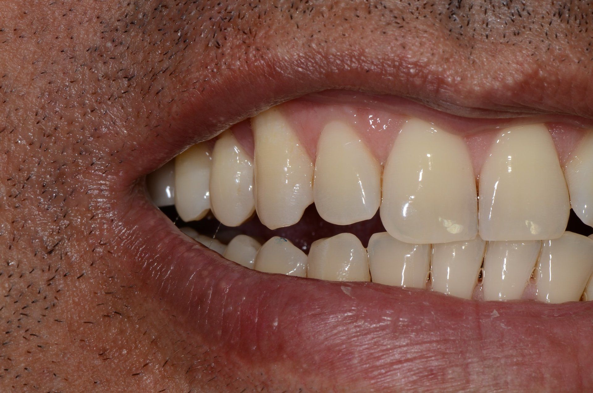 primo piano di denti paziente 16