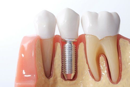 dente con impianto