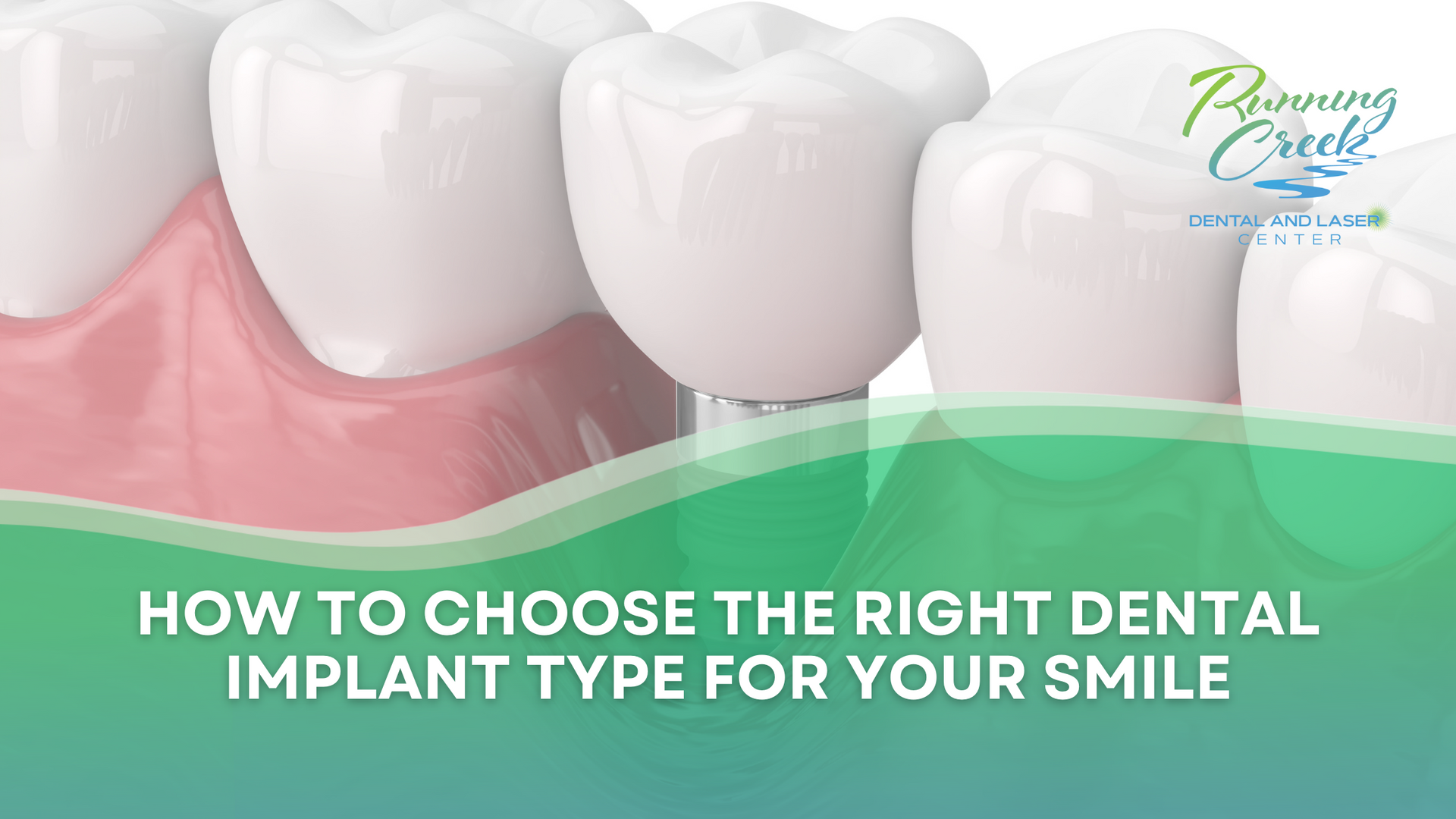 How to choose the right dental implant type for your smile