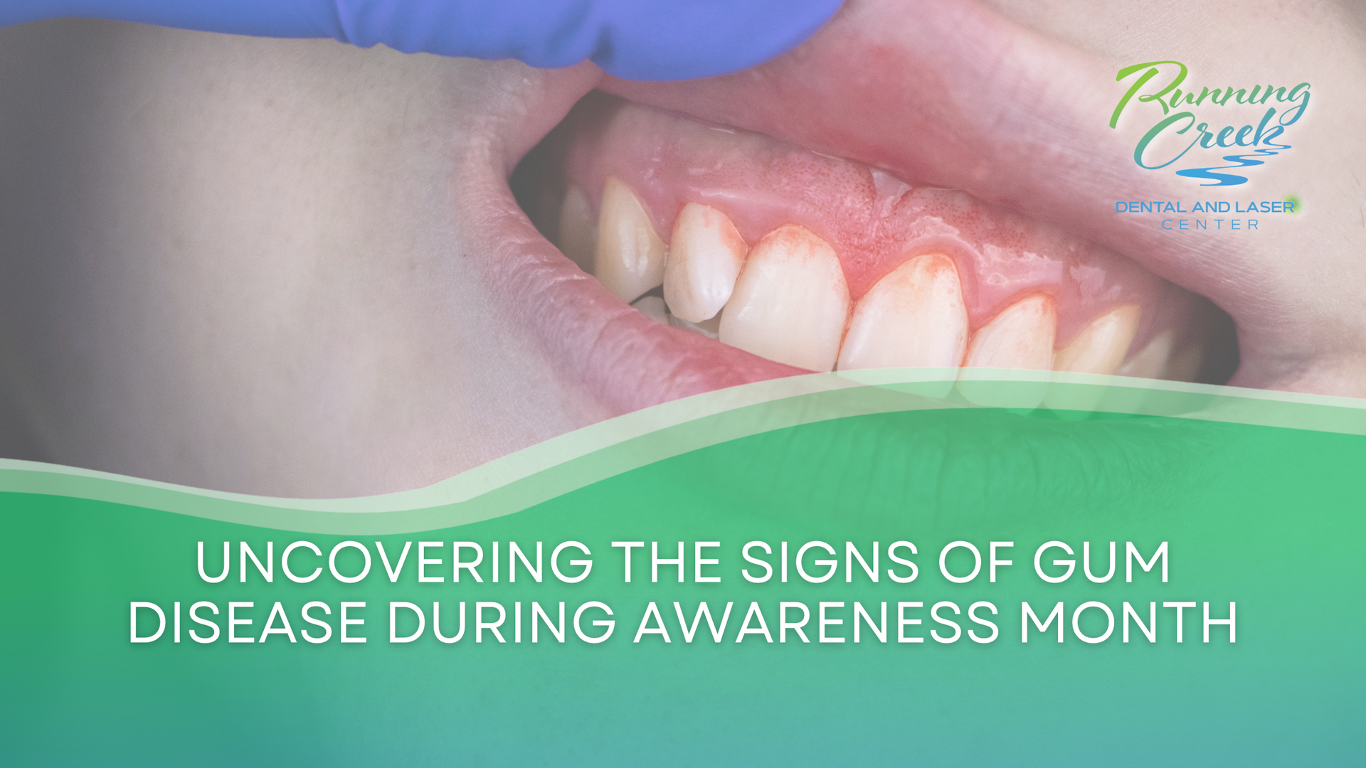 a person is uncovering the signs of gum disease during awareness month .