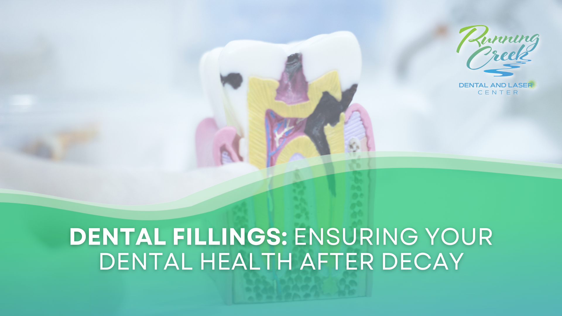 Dental fillings : ensuring your dental health after decay