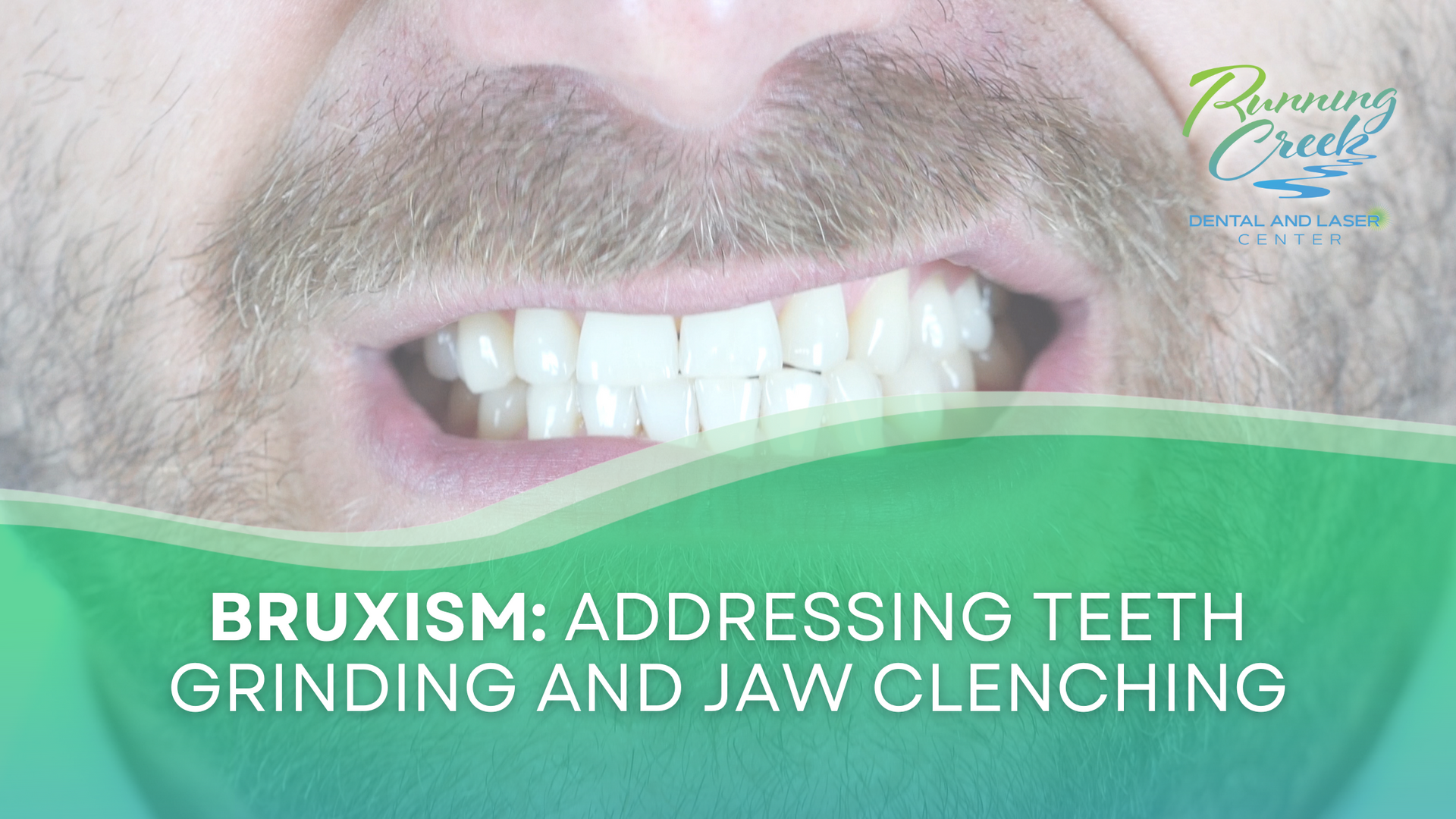 Bruxism : addressing teeth grinding and jaw clenching