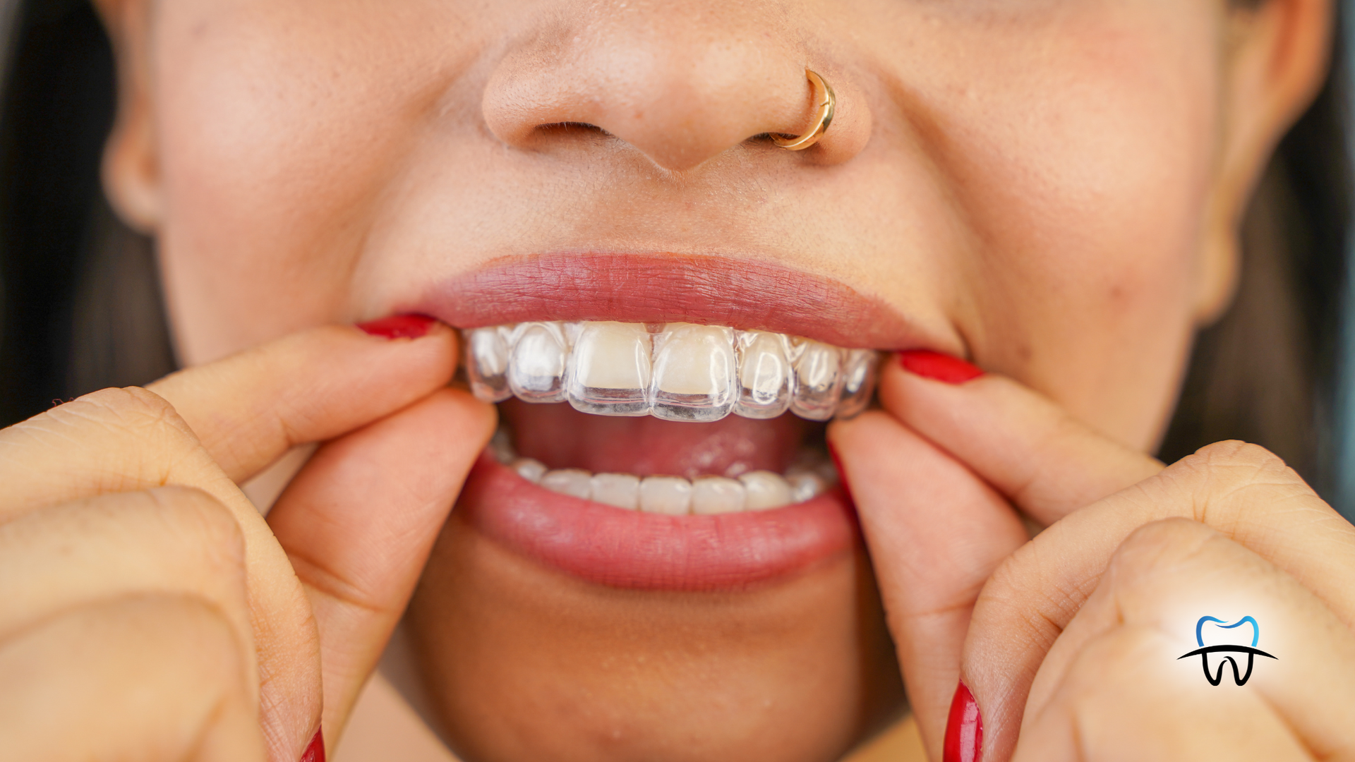 Person holding clear aligners in mouth, showing teeth.