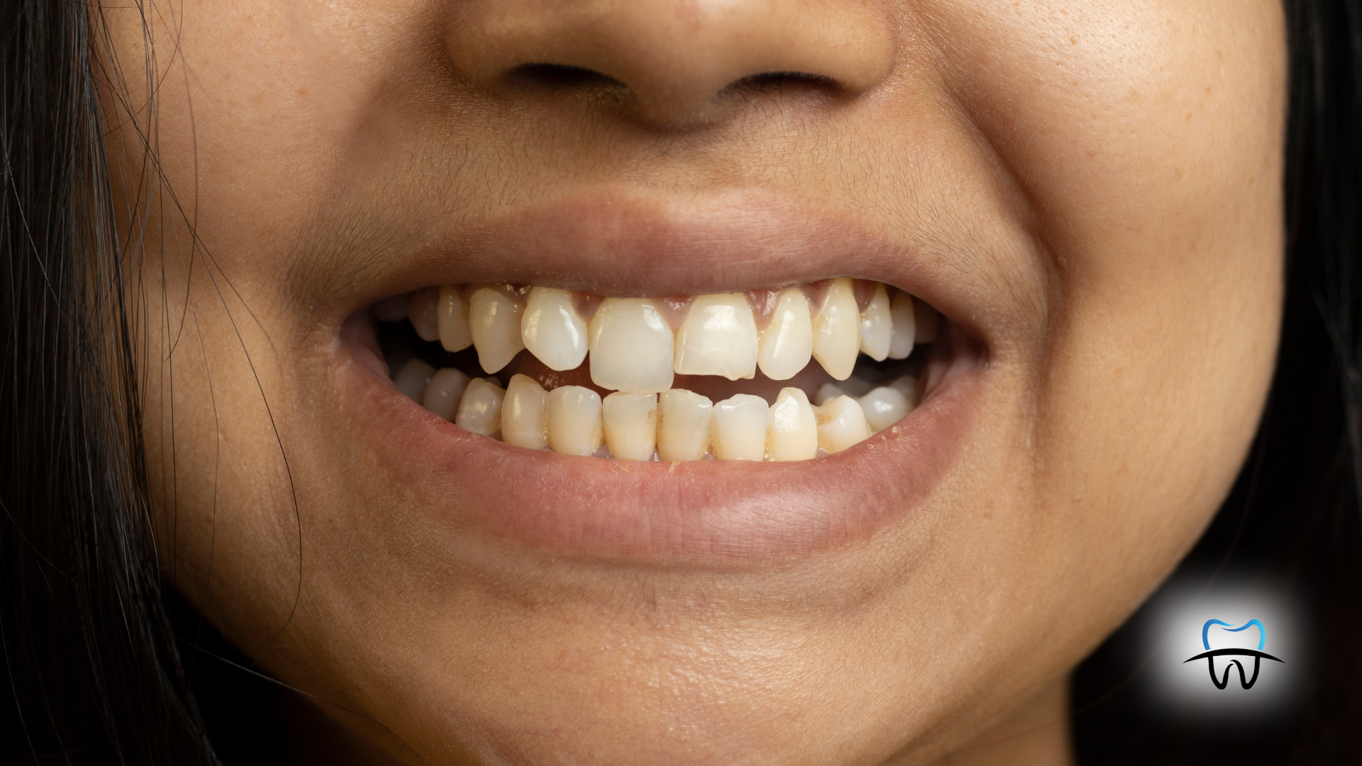 Close-up of teeth smiling, slight yellowing, uneven spacing.