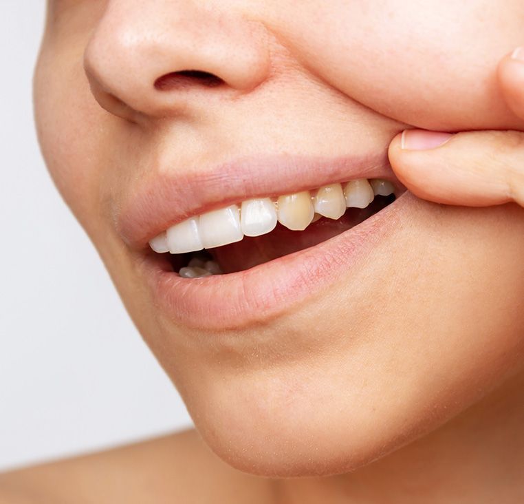 Close-up of a person's mouth, showing yellowing teeth next to whiter teeth, and fingers touching the cheek.