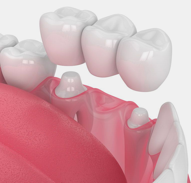 Dental bridge in the mouth, supported by two capped teeth with pink gums and white teeth.