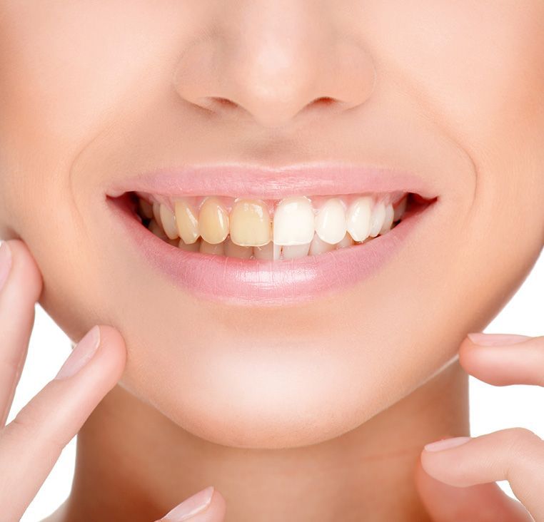 Smiling mouth, showing side-by-side comparison of yellow and whitened teeth, highlighting teeth whitening.