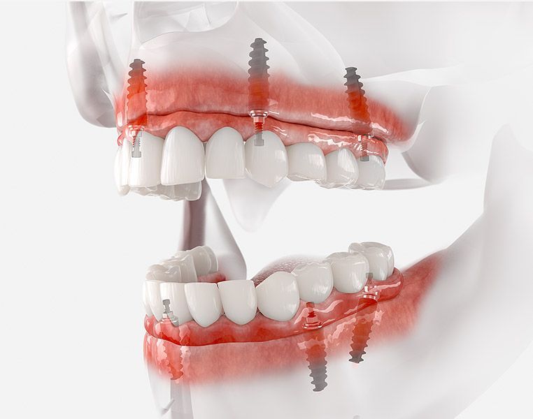 Dental illustration of dental implants in both upper and lower jaws.
