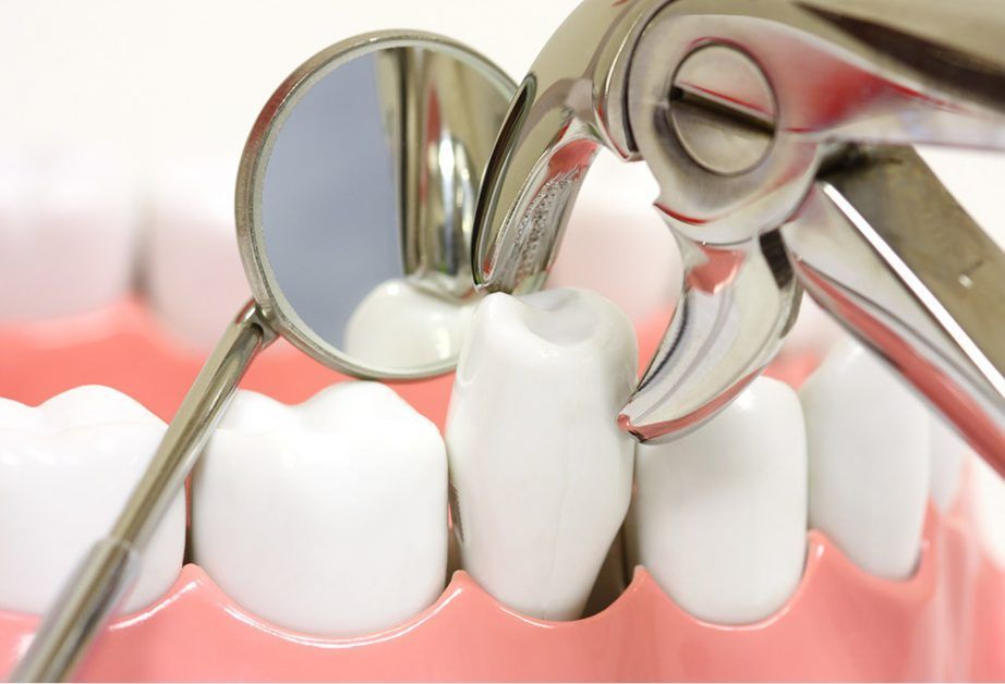 Dental tools (mirror, forceps) poised to extract a white tooth from a model mouth.