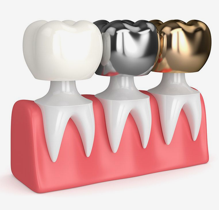 Illustration of dental crowns in white, silver, and gold on top of teeth and gums.