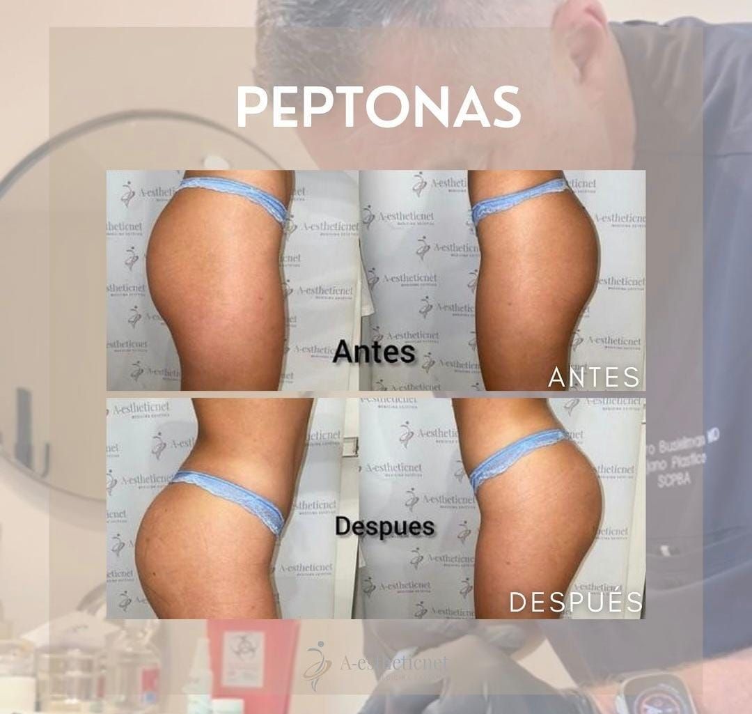 Comparación de glúteos antes y después de un tratamiento llamado