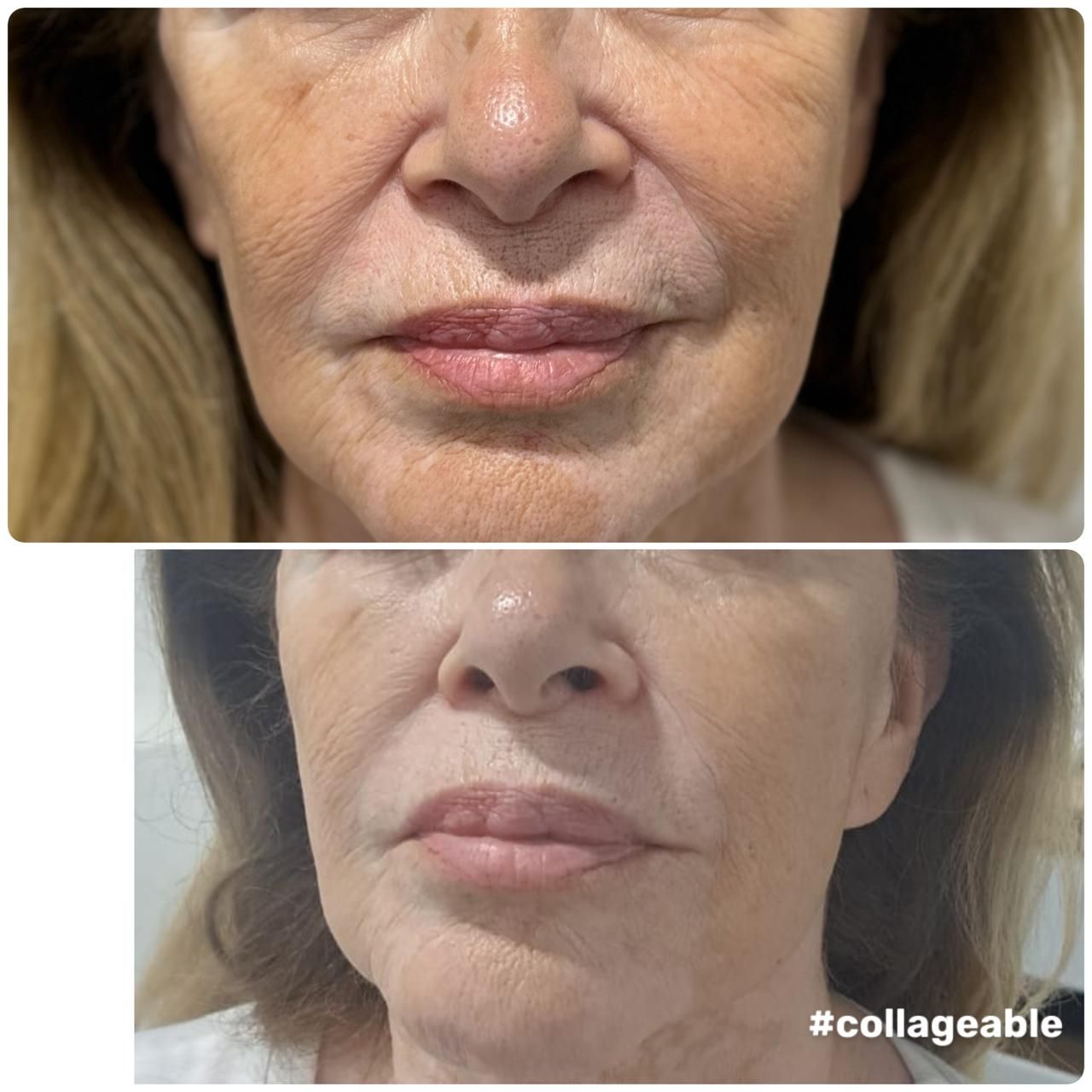 Comparación lado a lado de la parte inferior del rostro de una persona. Arriba: antes, con arrugas visibles.