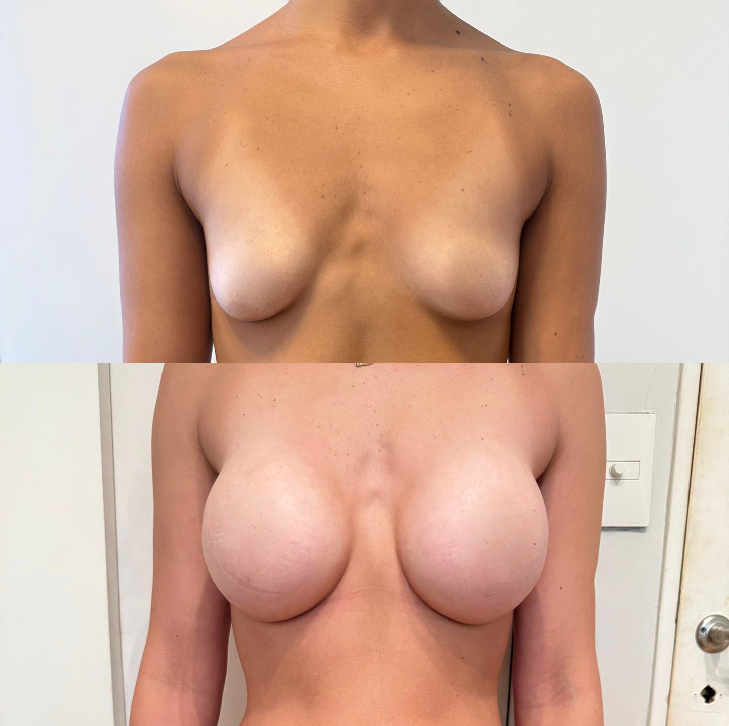 antes y después de cirugía de aumento mamario
