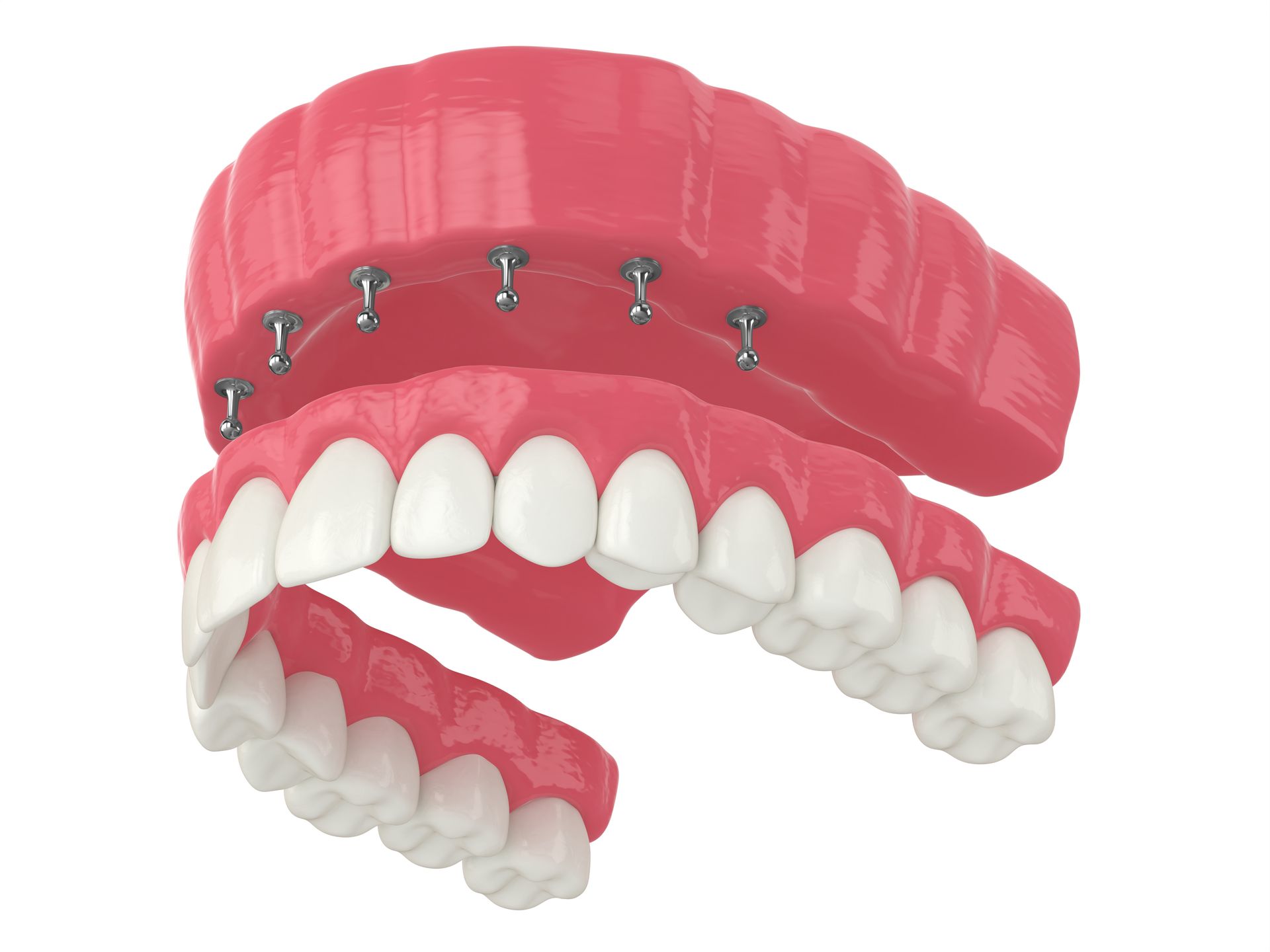 Implant supported dentures