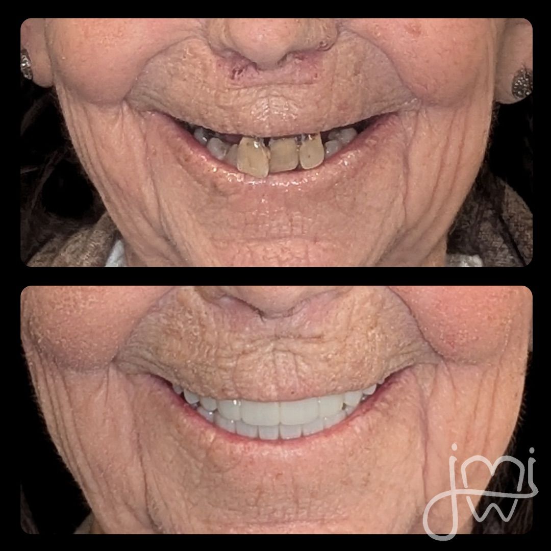 Before and after photos of a person's smile. The top shows discolored teeth, the bottom shows bright, white teeth.
